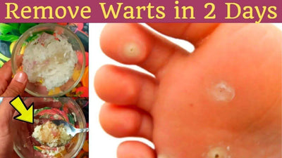 15 Home Remedies for Warts – Easy Home Wart Treatments