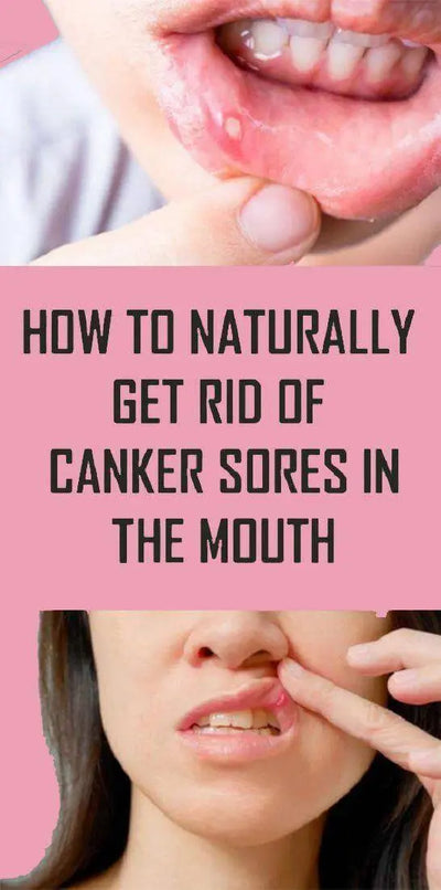 Canker Sore Treatment (How to Get Rid of Canker Sores)