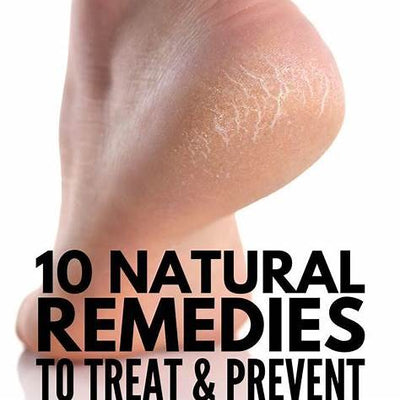 Unlock Softer Heels: 10 Powerful Natural Remedies for Cracked Heels (Red Onion, Sea Salt, Coconut Oil & More!)