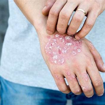 Effective Strategies for Managing Psoriasis on Hands: Causes, Remedies & Real-Life Tips
