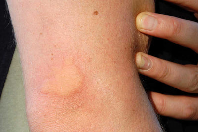 Deer Fly Bites: Your Ultimate Guide to Prevention, Treatment, and Identification in 2025