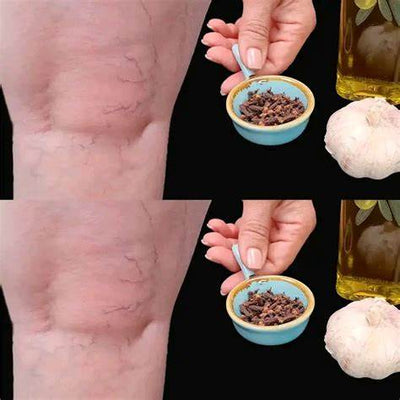 The Powerful Trio: Unveiling the Onion, Garlic, and Olive Oil Remedy for Varicose Veins in 2025