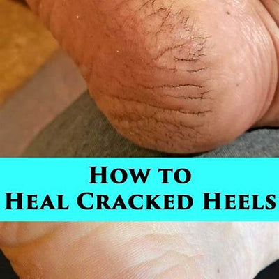 How to Heal Cracked Heels Naturally and Effectively at Home: Your Comprehensive Guide