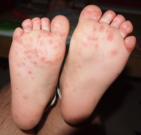 Hand, Foot and Mouth Disease – Symptoms, Prevention and Home Treatment