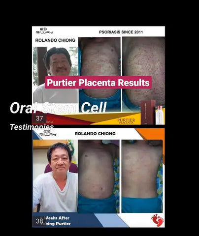 Purtier Placenta 6th edition oral Live Stem Cell Therapy in capsule - Benefits - Customer Review