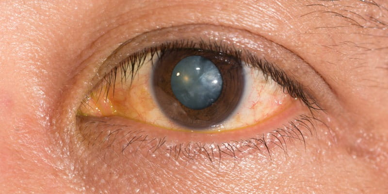 Nuclear Cataracts: Symptoms, Causes, and Treatment
