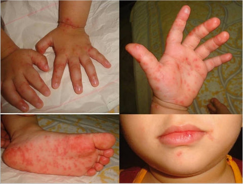 Hand, Foot and Mouth Disease – Symptoms, Prevention and Home Treatment