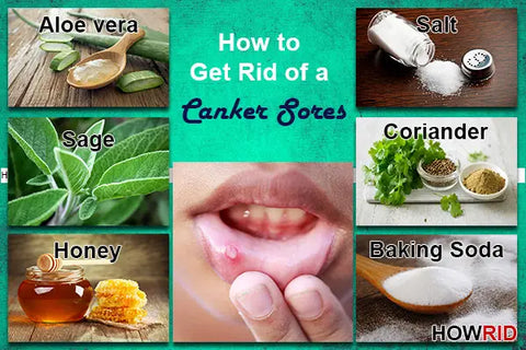 Canker Sore Treatment (How to Get Rid of Canker Sores)